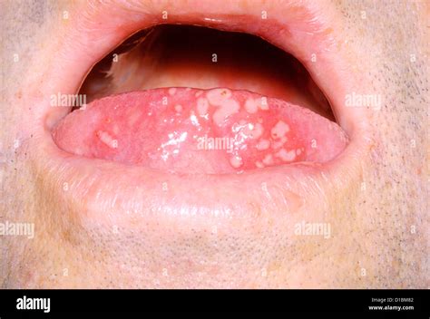 what is herpes on tongue